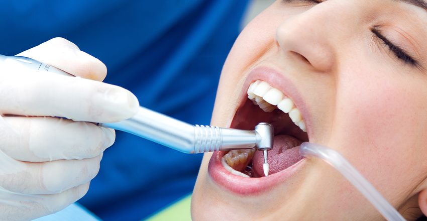 Mitos y verdades sobre las limpiezas dentales